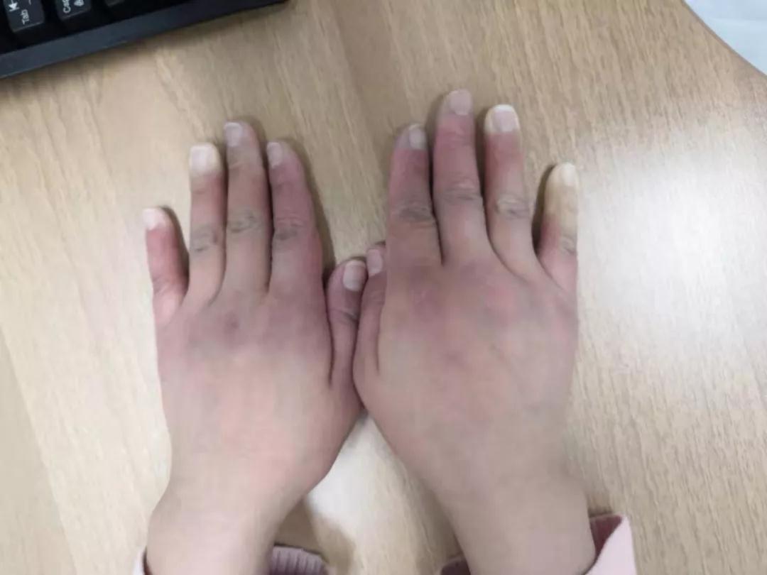 “手指、腳趾發(fā)白、發(fā)紫……”這些“小毛病”千萬別大意