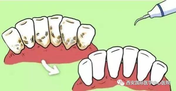 【科普】牙齒上的黃斑好難看，三招告訴你如何預(yù)防氟斑牙