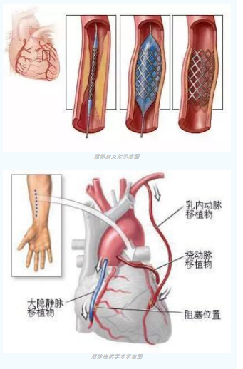 魚與熊掌不可兼得？冠脈雜交手術(shù)一站式解決問(wèn)題