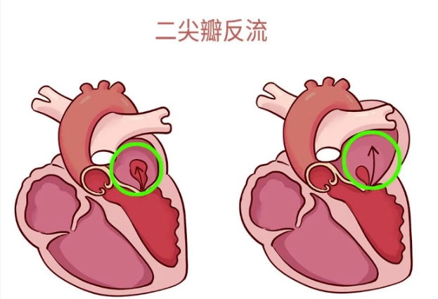 體檢報(bào)告里的心臟瓣膜返流，你讀懂了嗎？